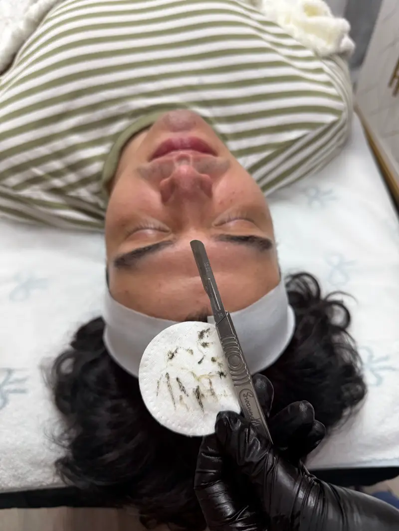 Dermaplaning in progress, with removed peach fuzz on a cotton pad